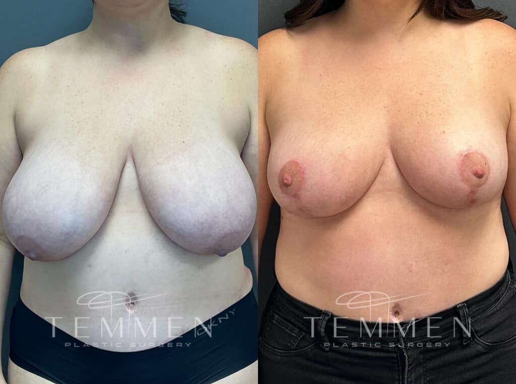 Breast Lift Before & After