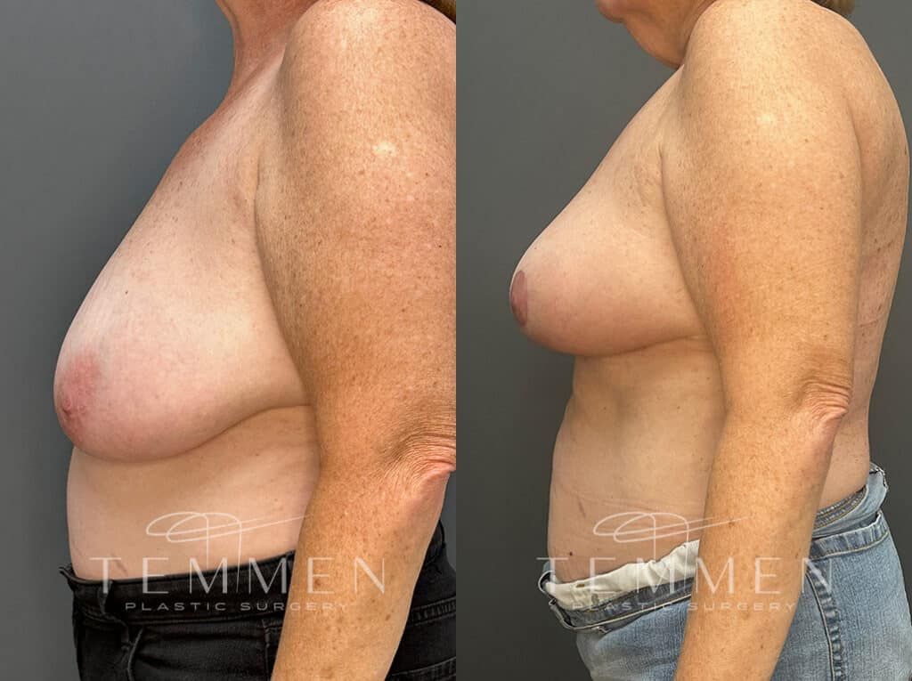 Breast Lift Before & After