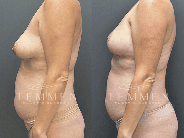 Breast Lift Before & After