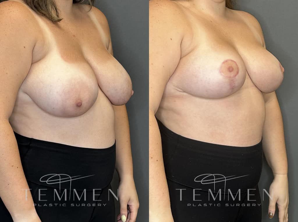 Breast Lift Before & After