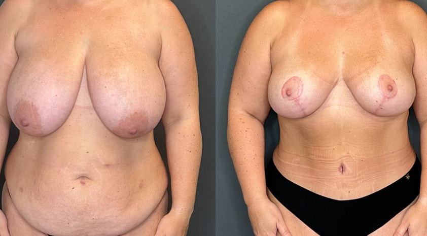 Breast Lift Before & After