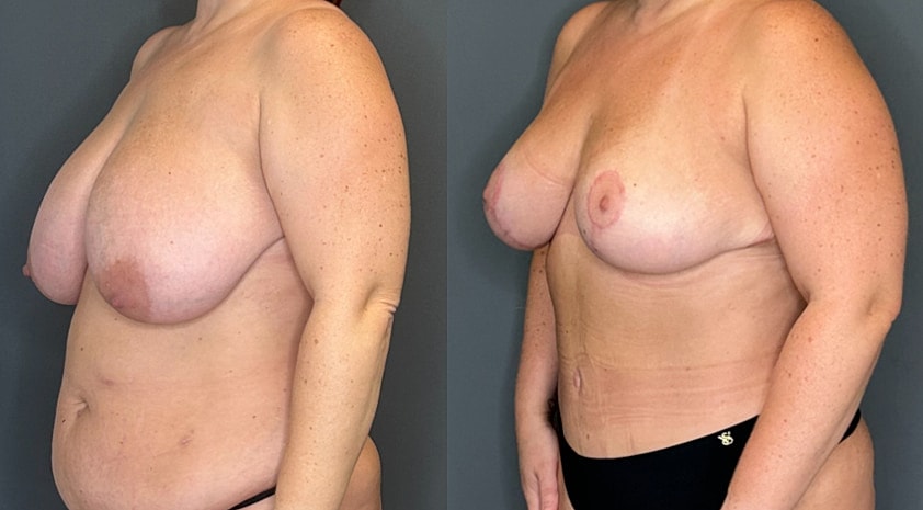 Breast Lift Before & After