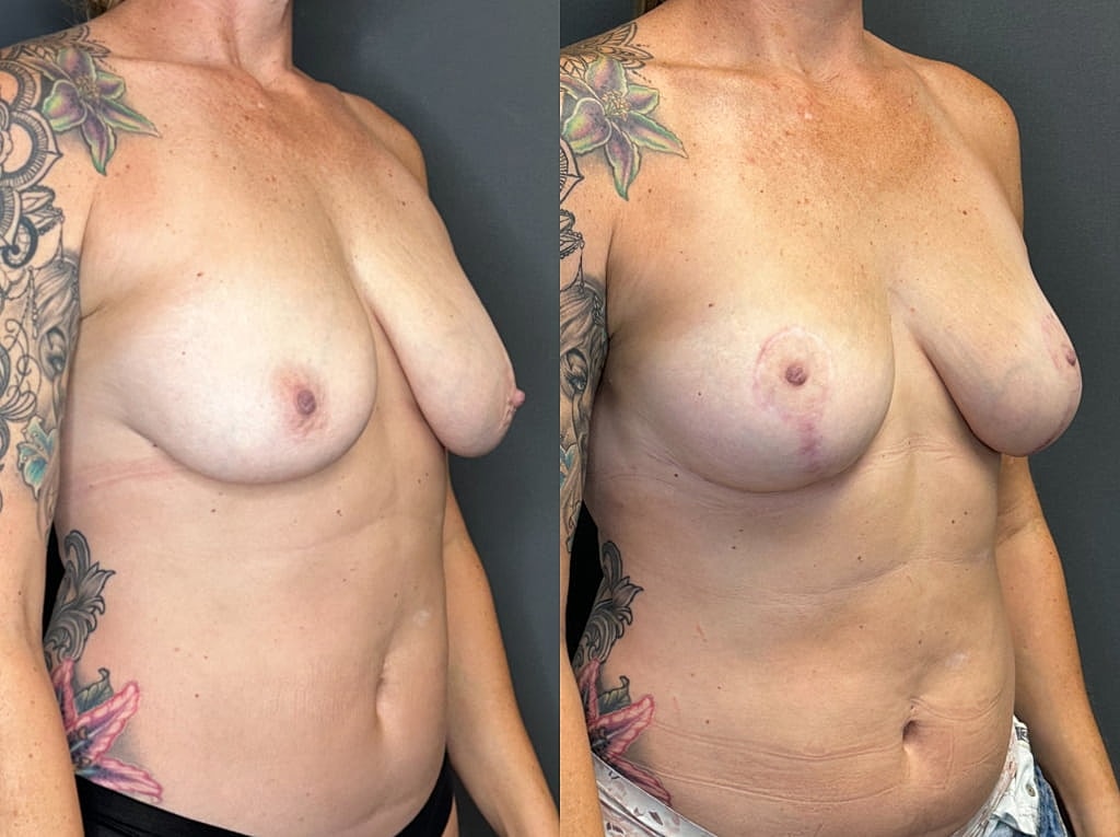 Breast Lift Before & After