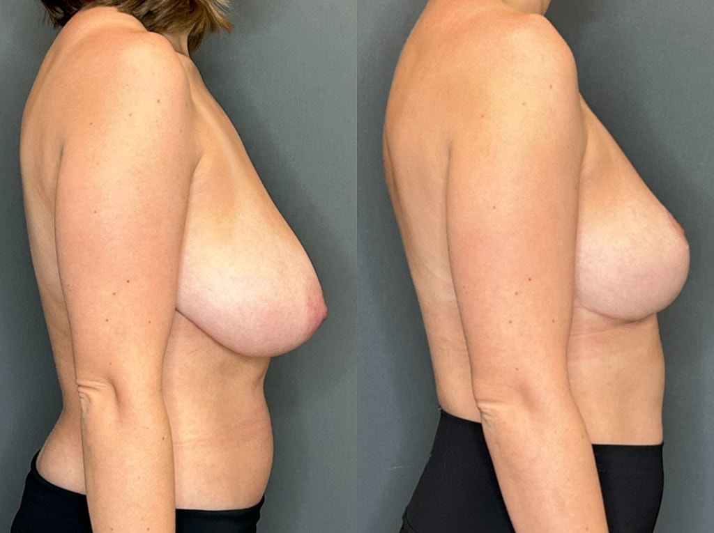 Breast Lift Before & After
