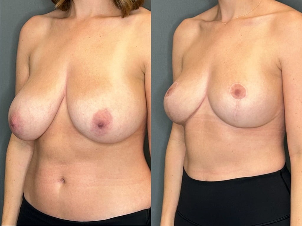 Breast Lift Before & After
