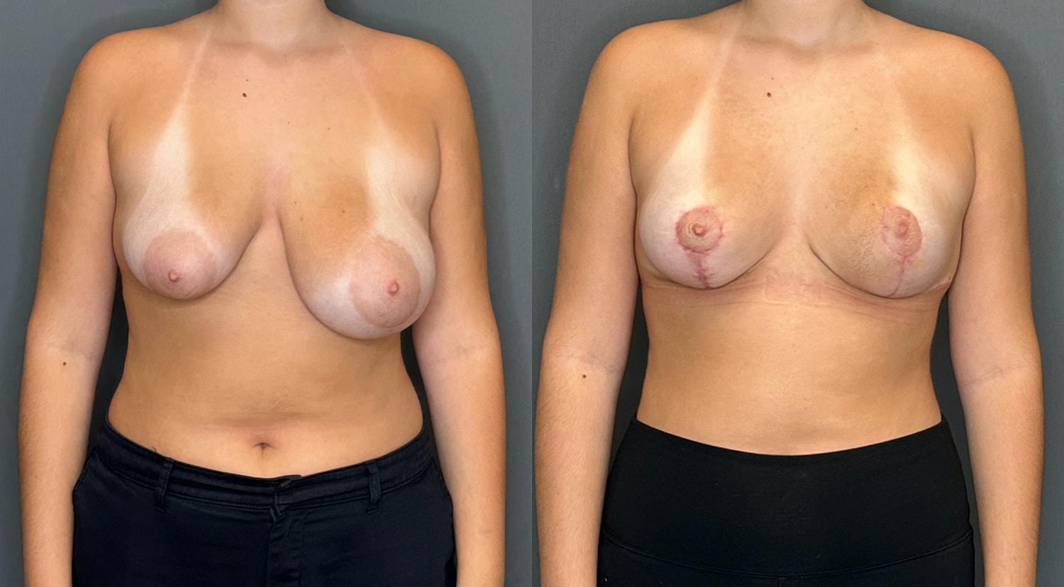 Breast Lift Before & After