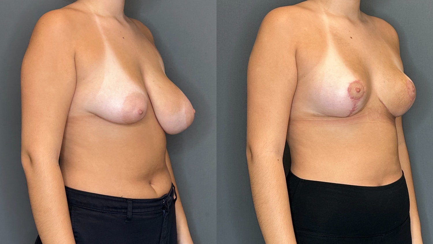 Breast Lift Before & After