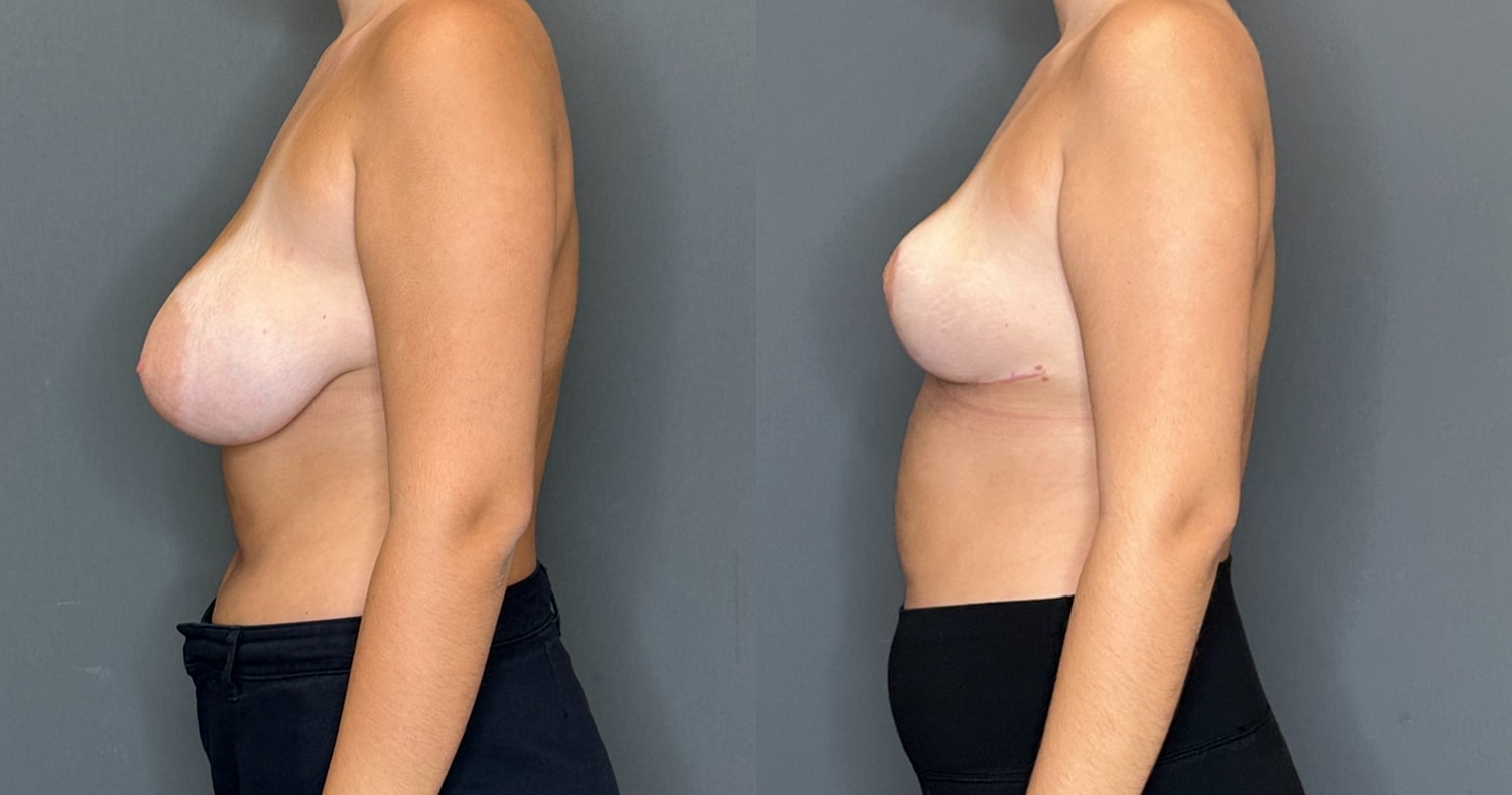 Breast Lift Before & After