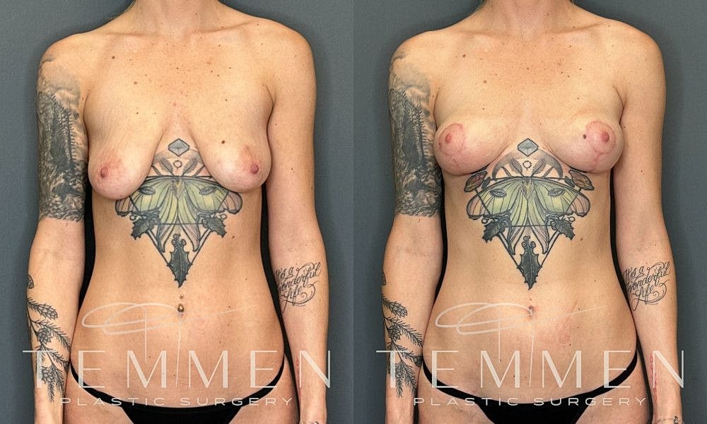 Breast Lift Before & After