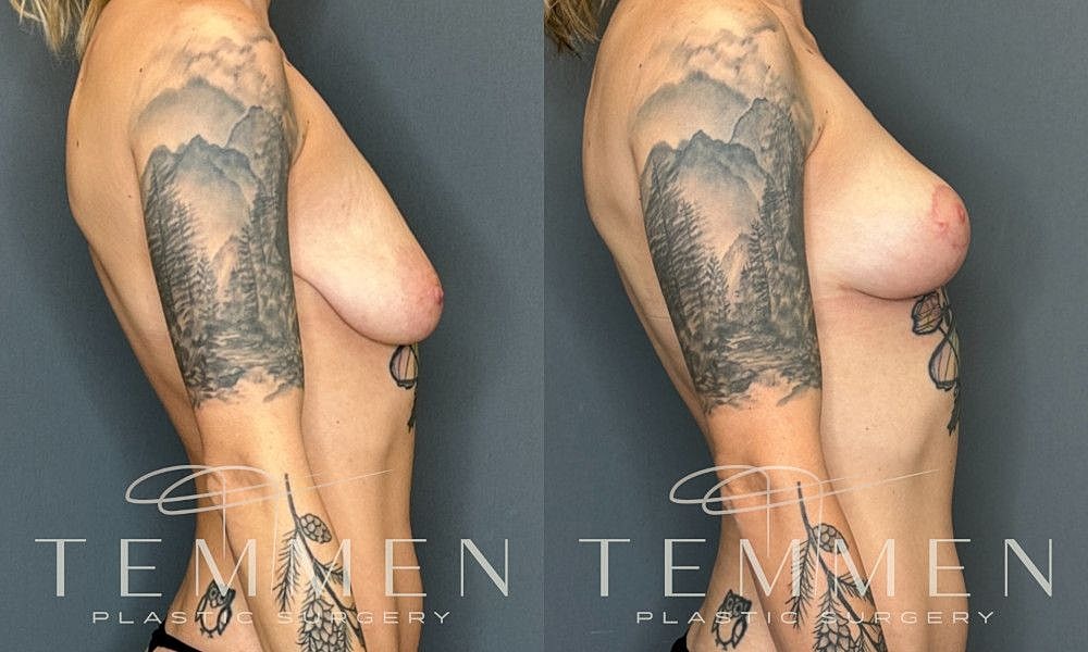 Breast Lift Before & After