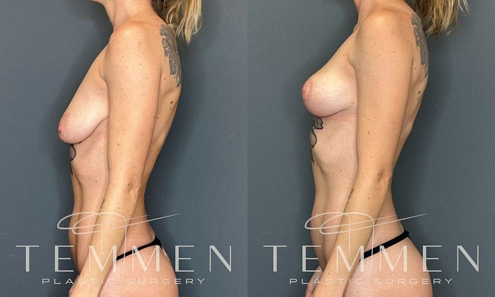 Breast Lift Before & After