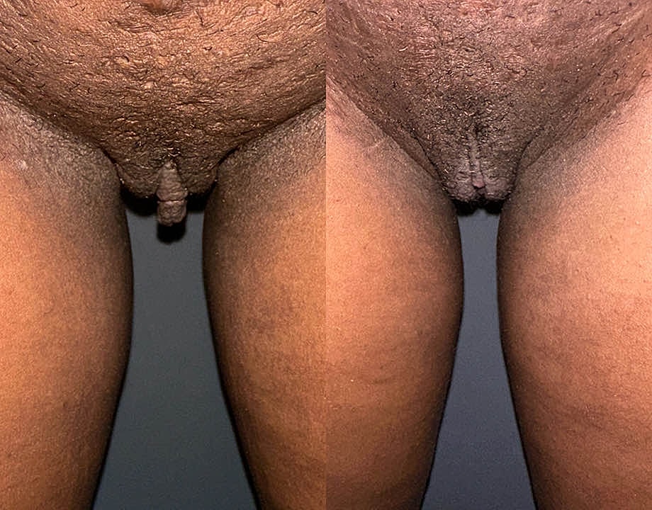 Perineoplasty Before & After