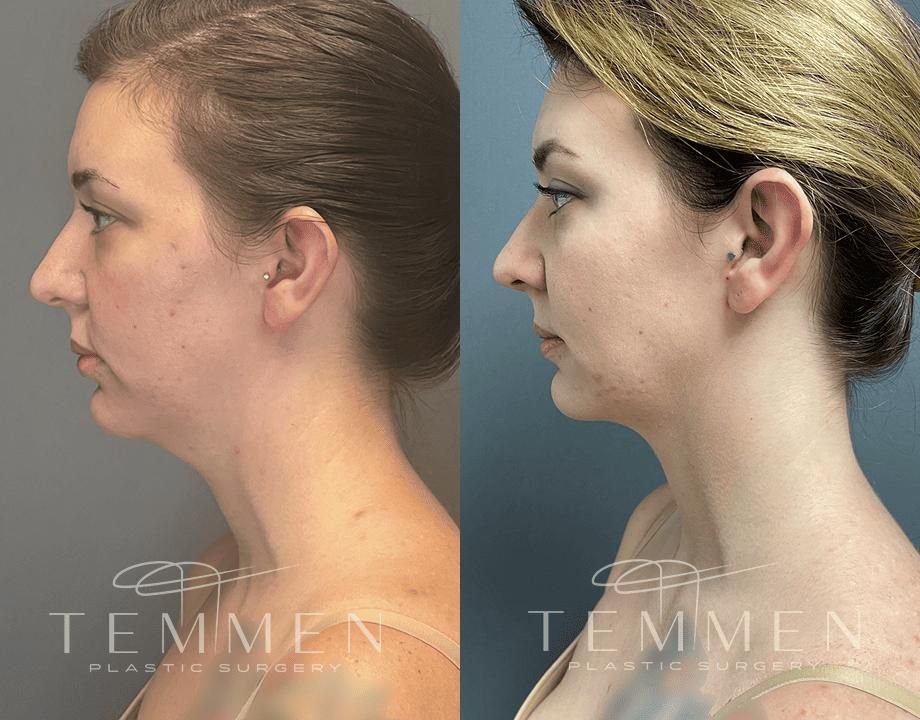 Face Liposuction Before & After