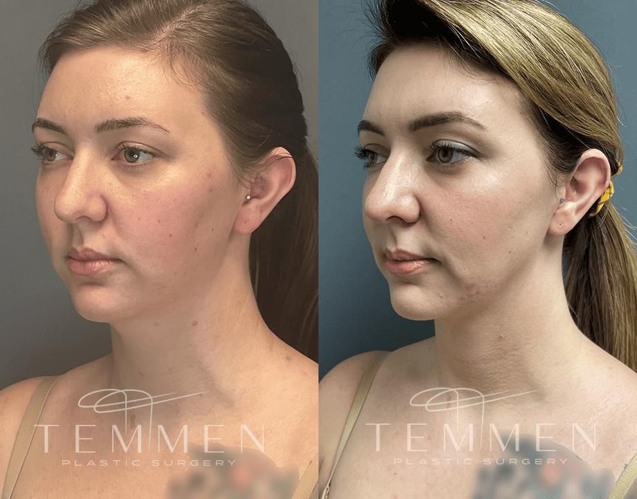 Face Liposuction Before & After