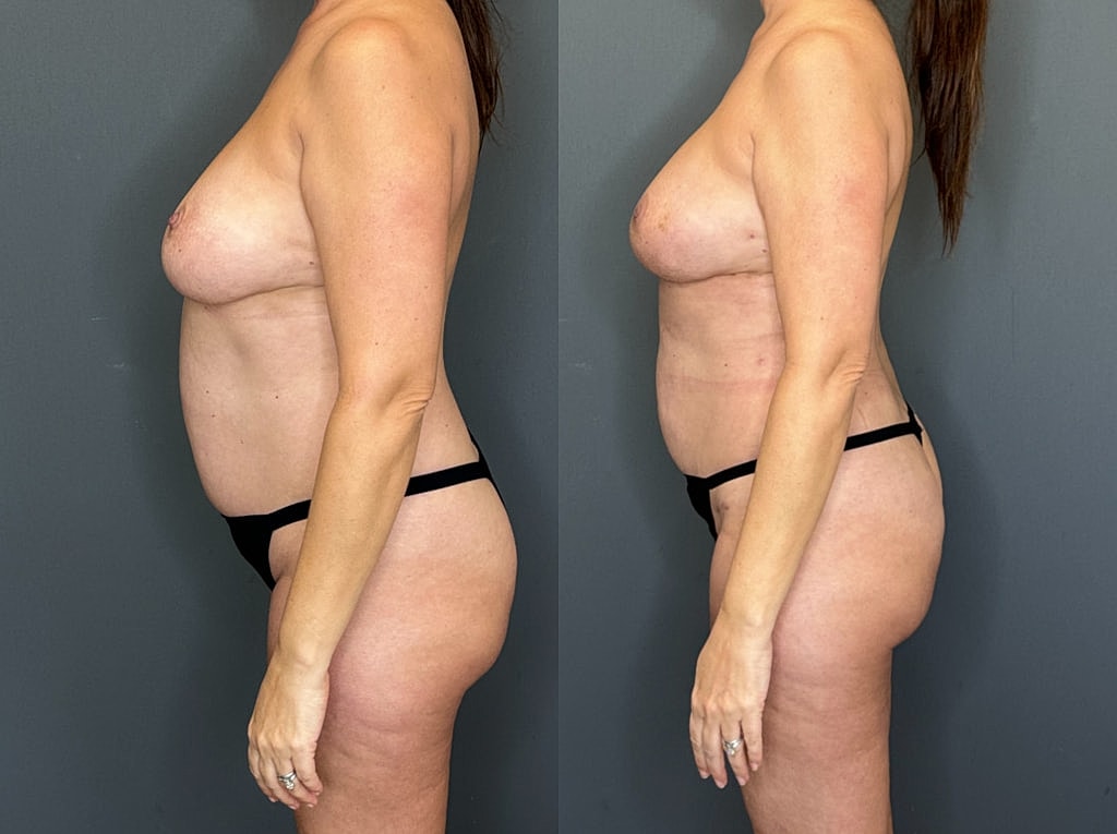 Implant Removal With Fat Transfer Before & After