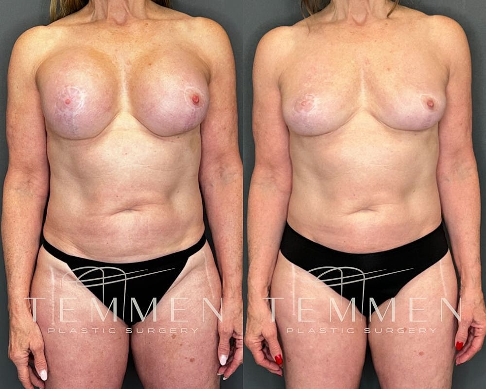 Before and after cosmetic surgery transformation.