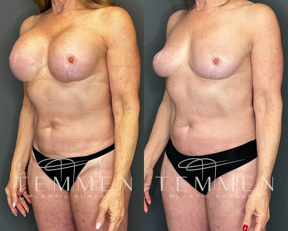 Before and after breast augmentation comparison photo.