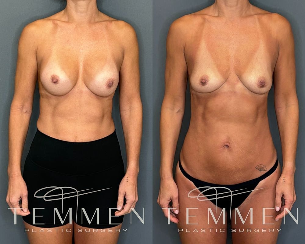 Implant Removal With Fat Transfer Before & After