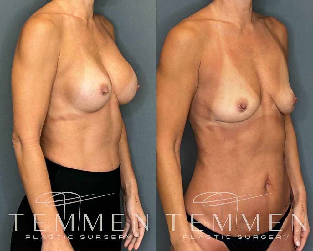 Implant Removal With Fat Transfer Before & After