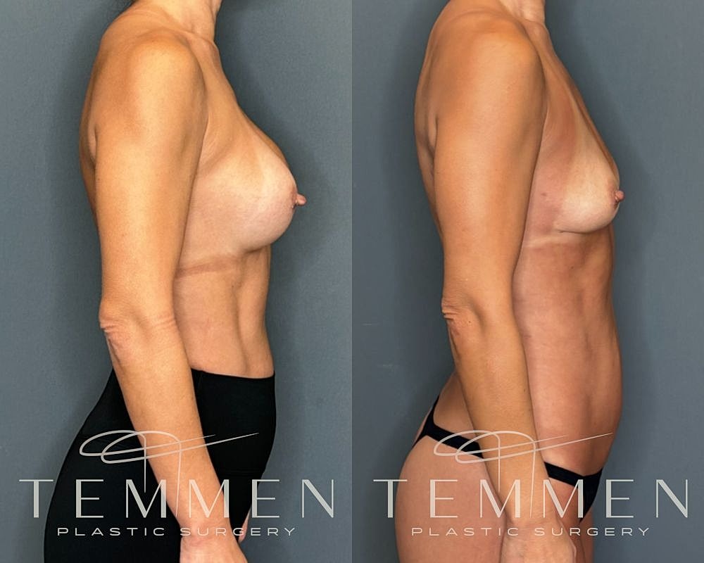Implant Removal With Fat Transfer Before & After