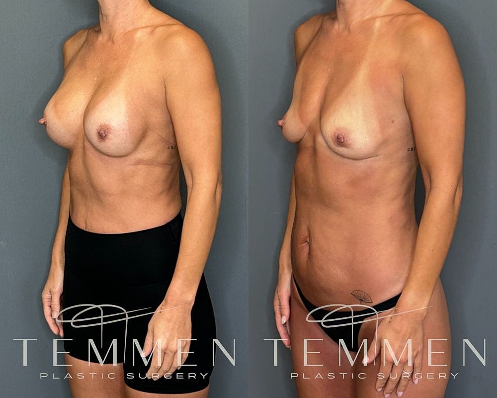 Implant Removal With Fat Transfer Before & After