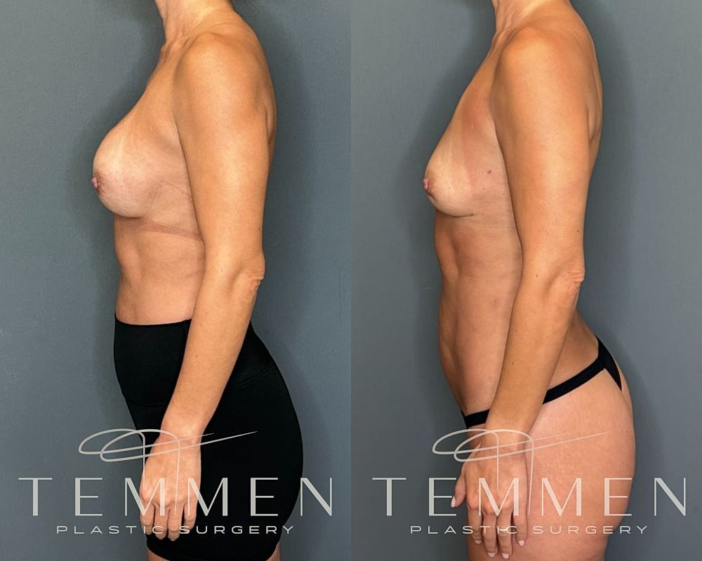 Implant Removal With Fat Transfer Before & After