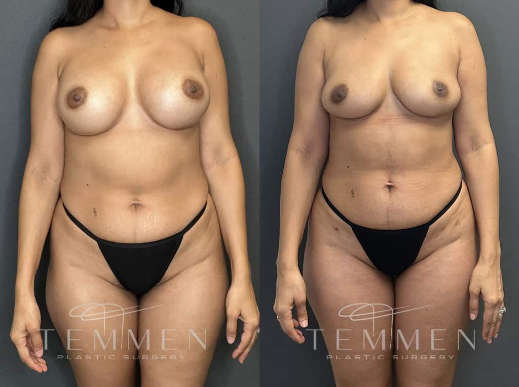 Implant Removal With Fat Transfer Before & After
