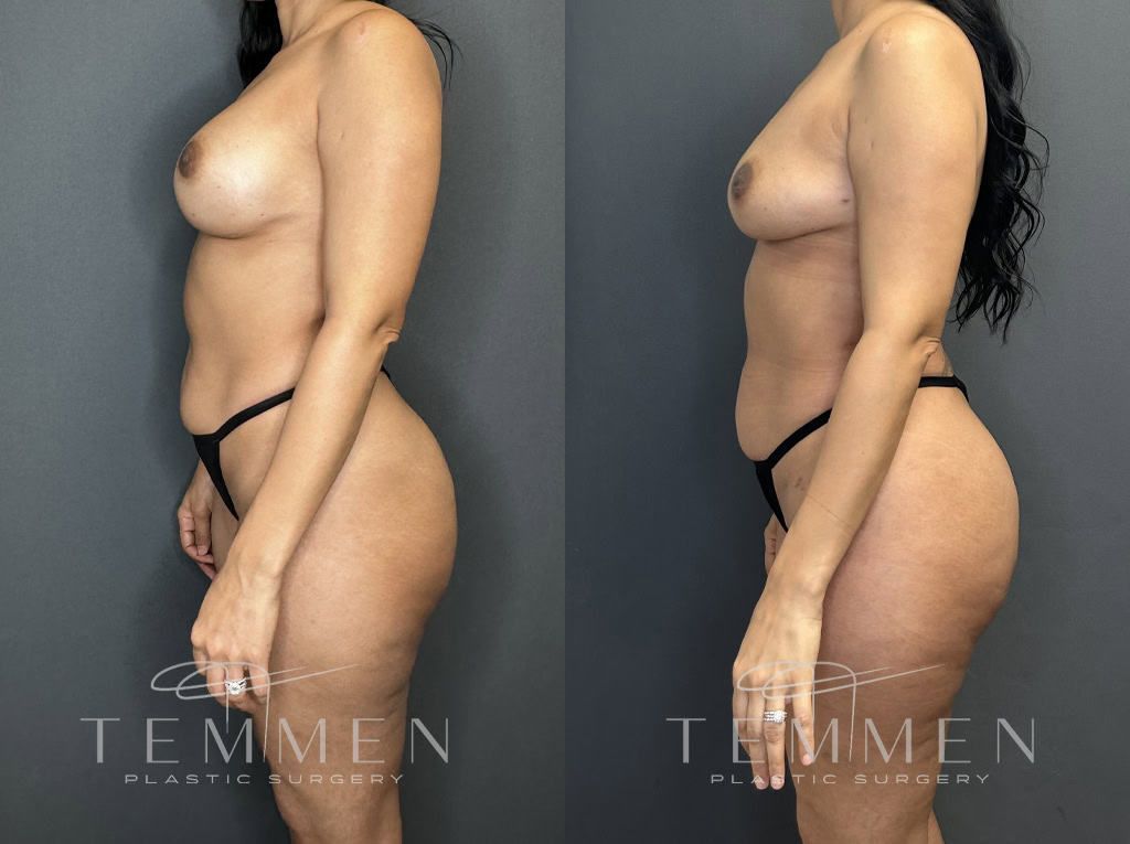 Implant Removal With Fat Transfer Before & After