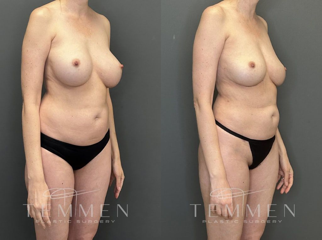 Implant Removal With Fat Transfer Before & After