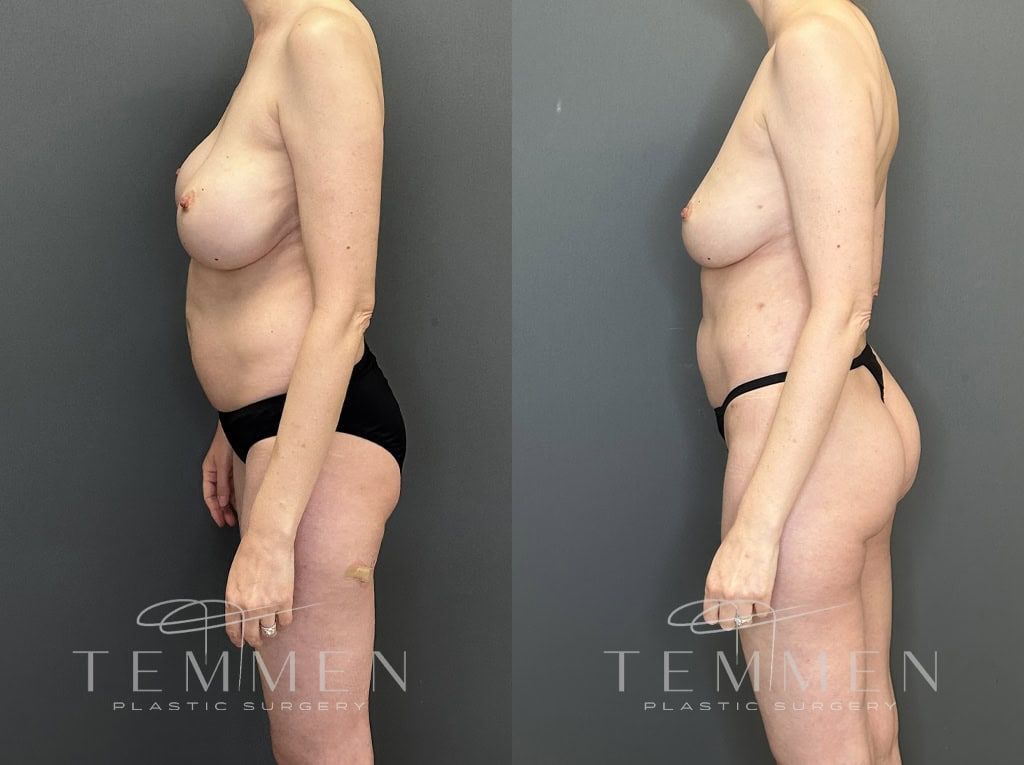 Implant Removal With Fat Transfer Before & After