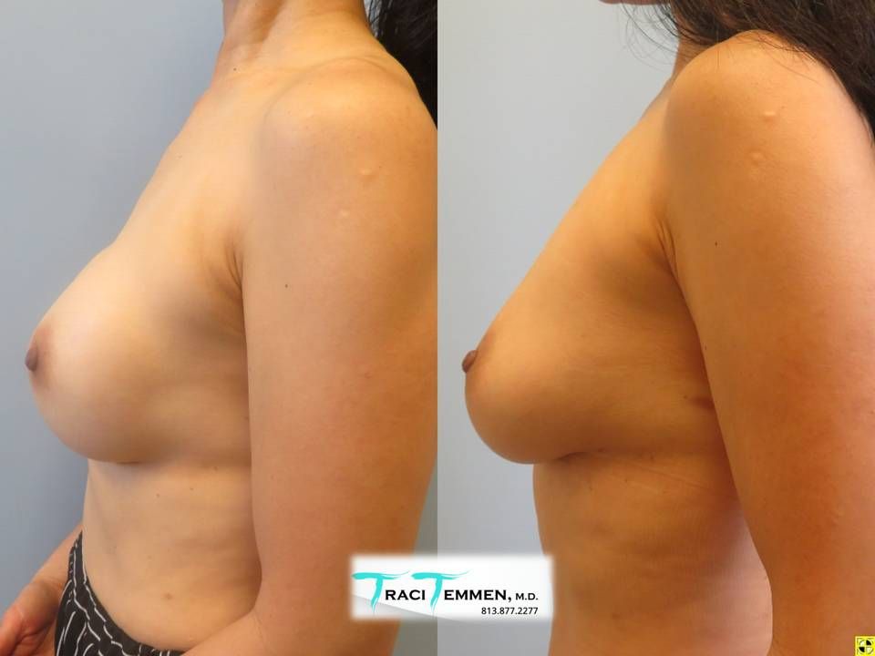 Implant Removal With Fat Transfer Before & After