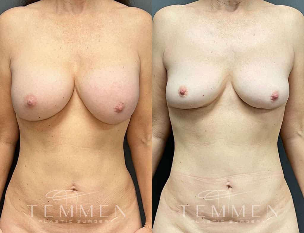 Implant Removal With Fat Transfer Before & After