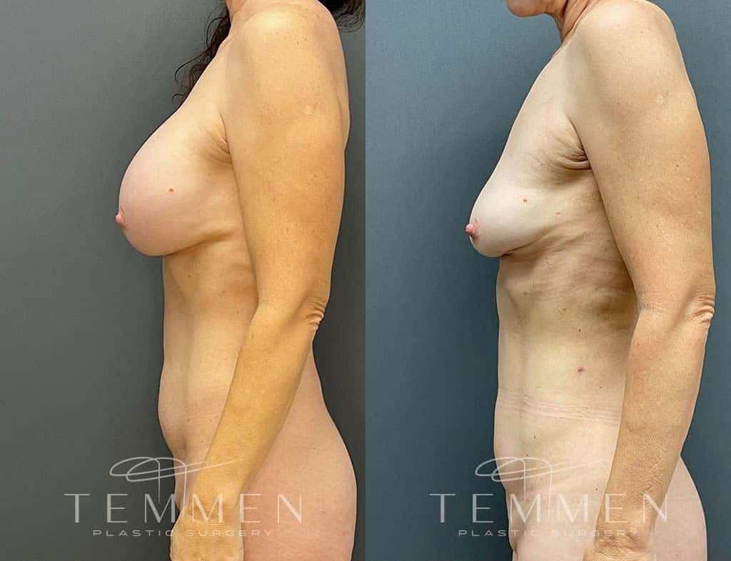 Implant Removal With Fat Transfer Before & After