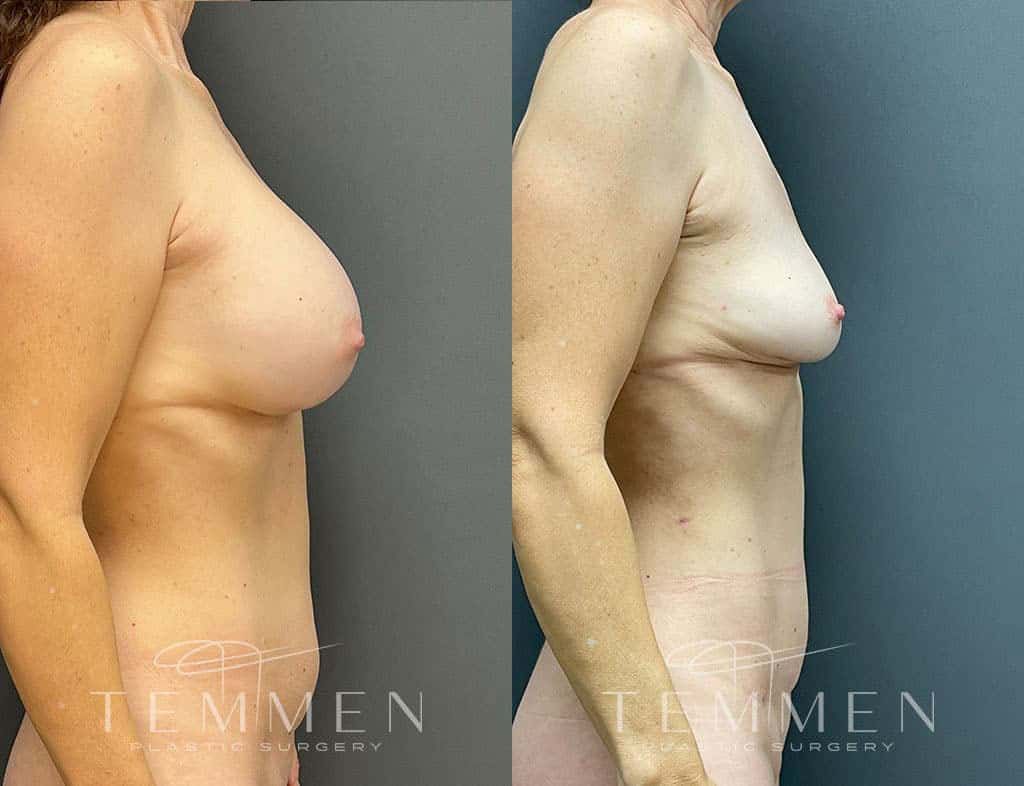 Implant Removal With Fat Transfer Before & After