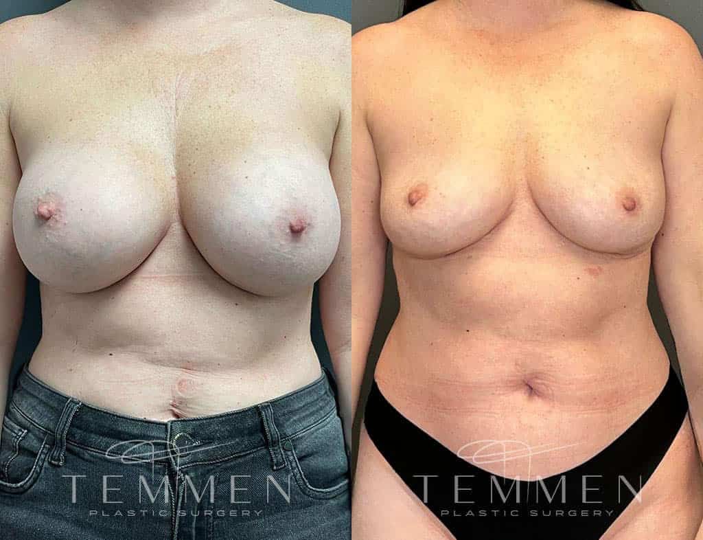 Implant Removal With Fat Transfer Before & After