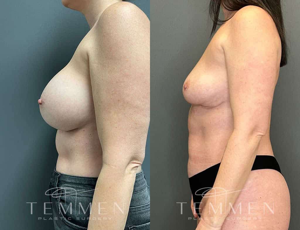 Implant Removal With Fat Transfer Before & After