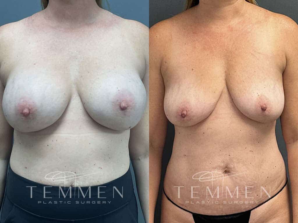 Implant Removal With Fat Transfer Before & After