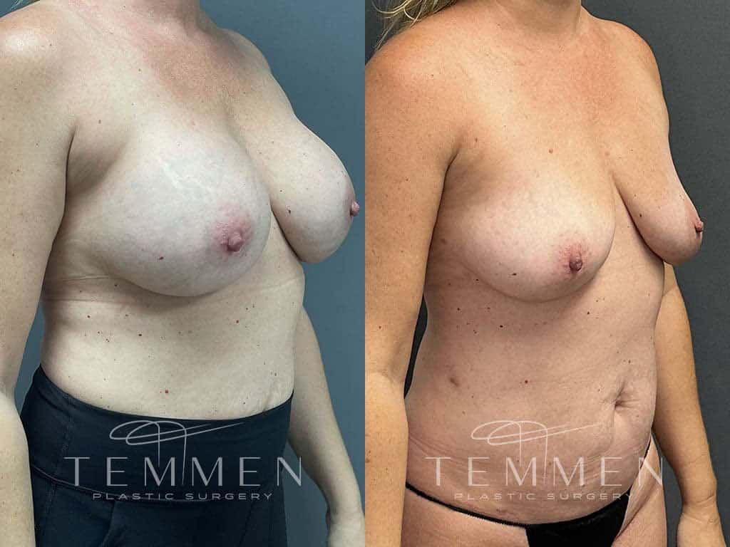 Implant Removal With Fat Transfer Before & After