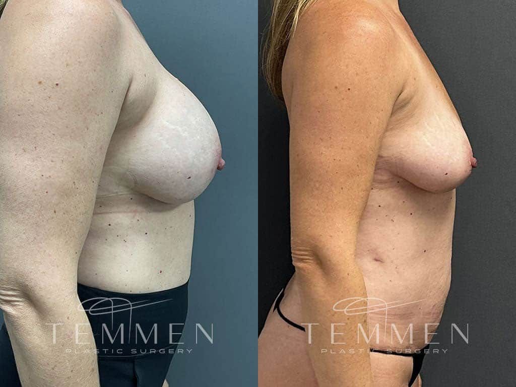 Implant Removal With Fat Transfer Before & After