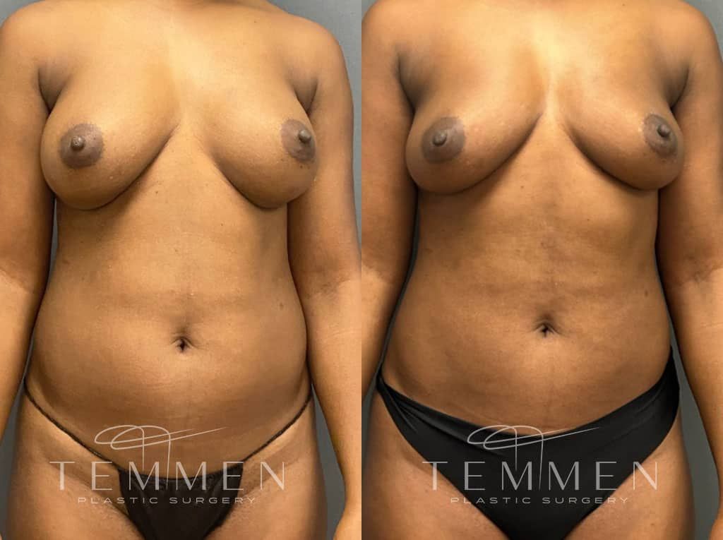Implant Removal With Fat Transfer Before & After