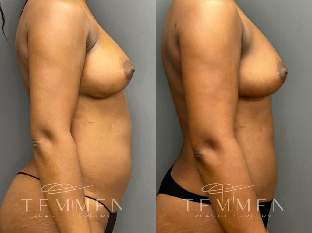 Implant Removal With Fat Transfer Before & After
