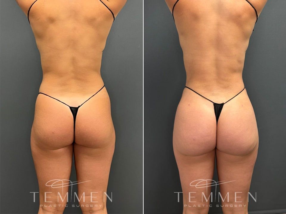 Brazilian Butt Lift Before & After