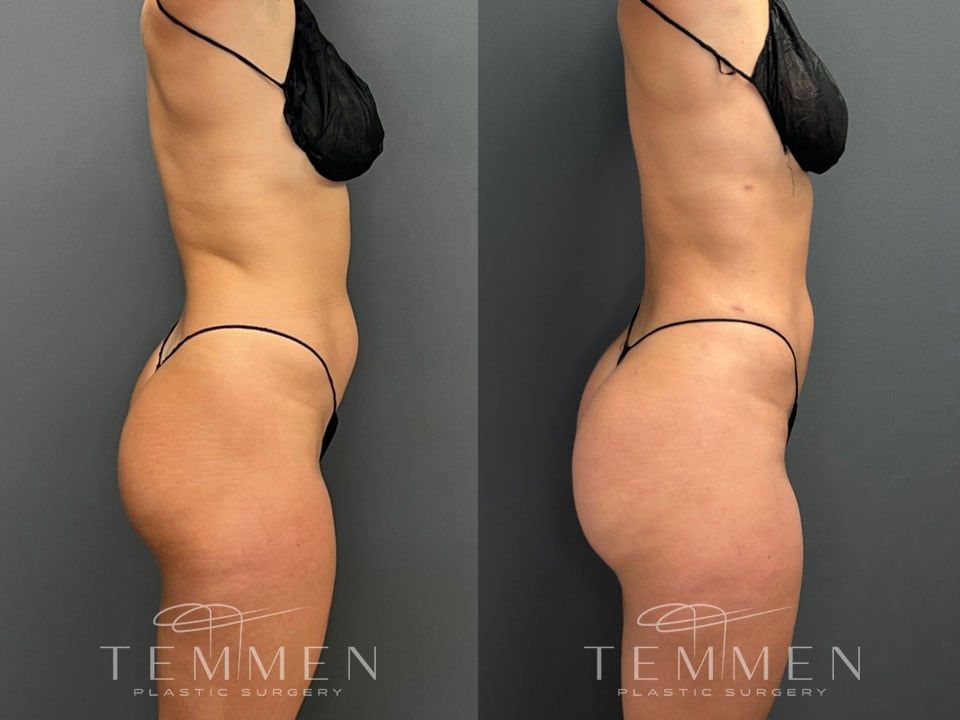 Brazilian Butt Lift Before & After