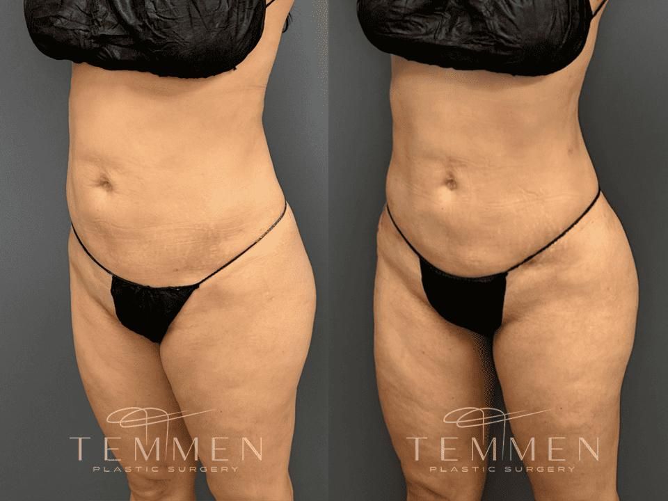 Brazilian Butt Lift Before & After