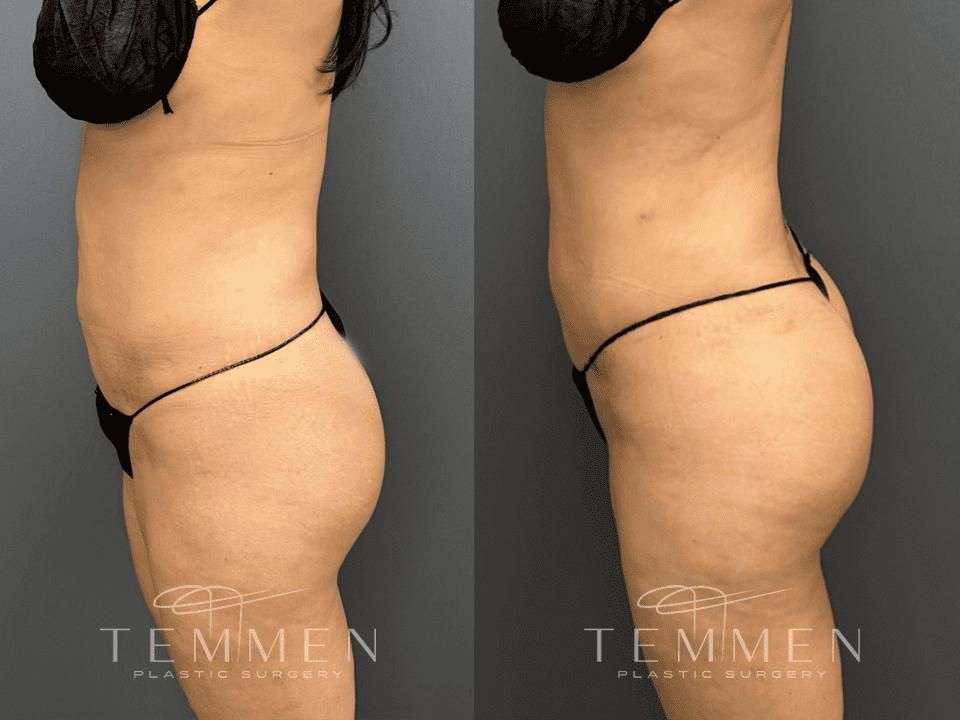 Brazilian Butt Lift Before & After