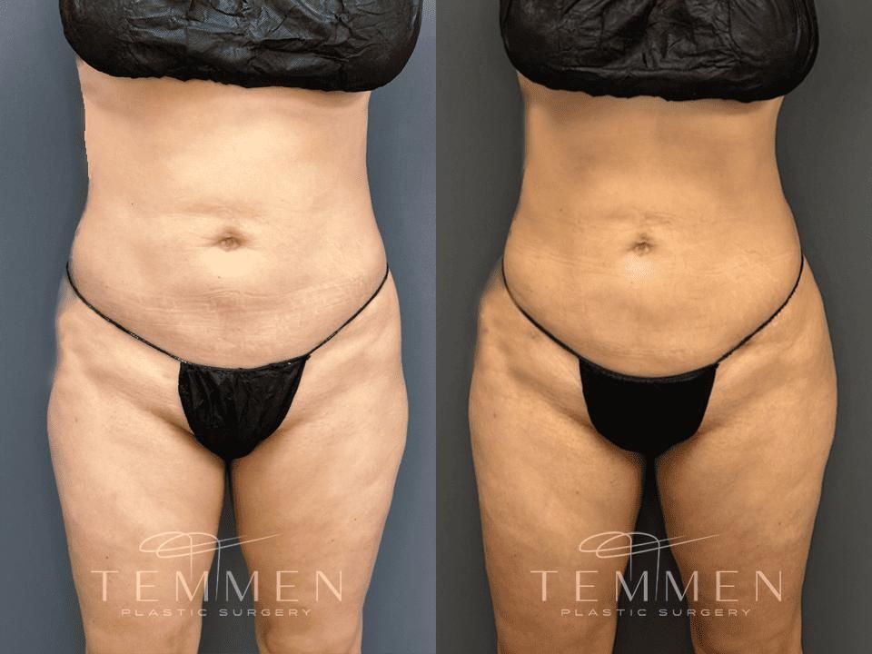 Brazilian Butt Lift Before & After