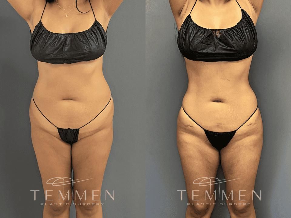 Brazilian Butt Lift Before & After