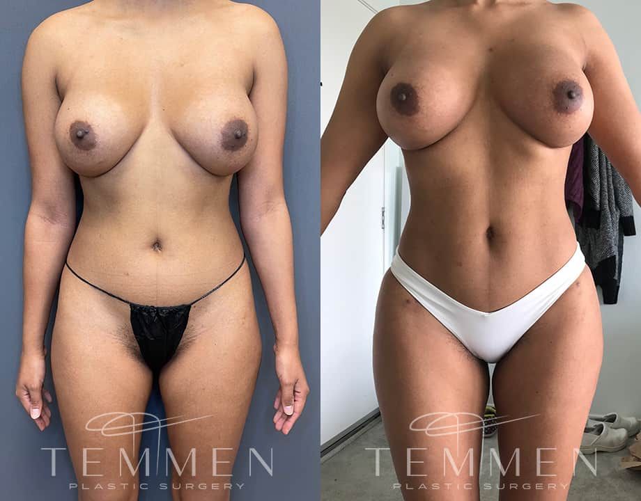 Brazilian Butt Lift Before & After