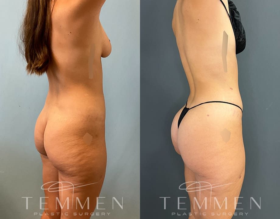 Brazilian Butt Lift Before & After