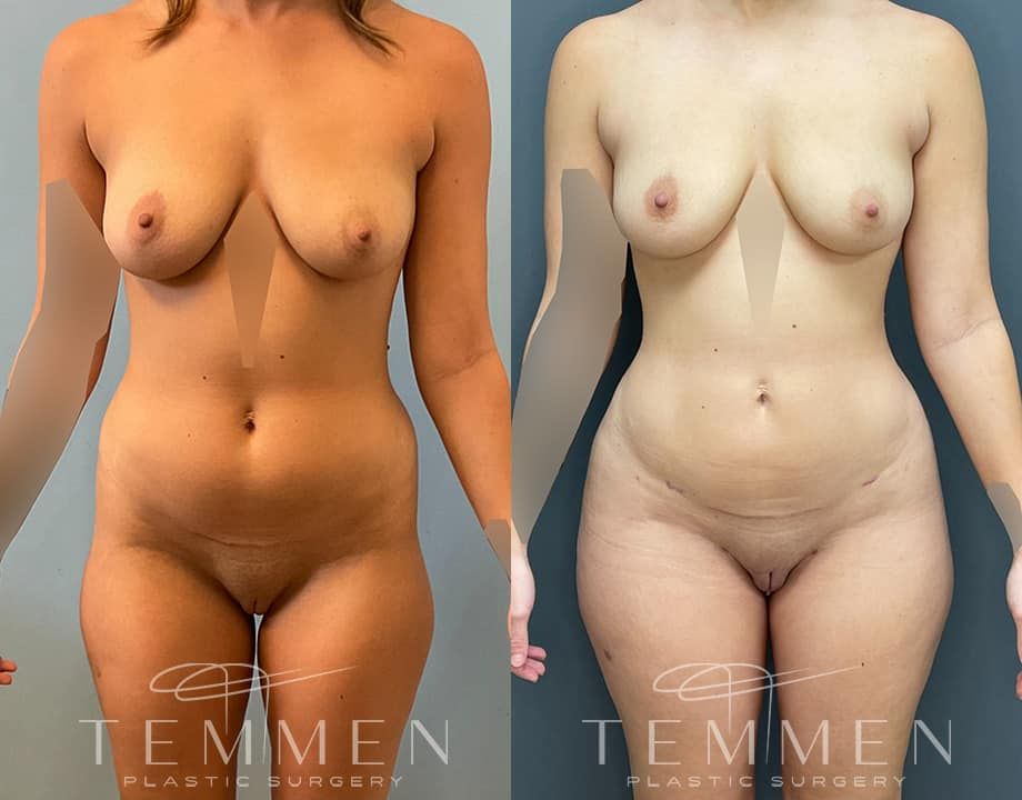 Brazilian Butt Lift Before & After